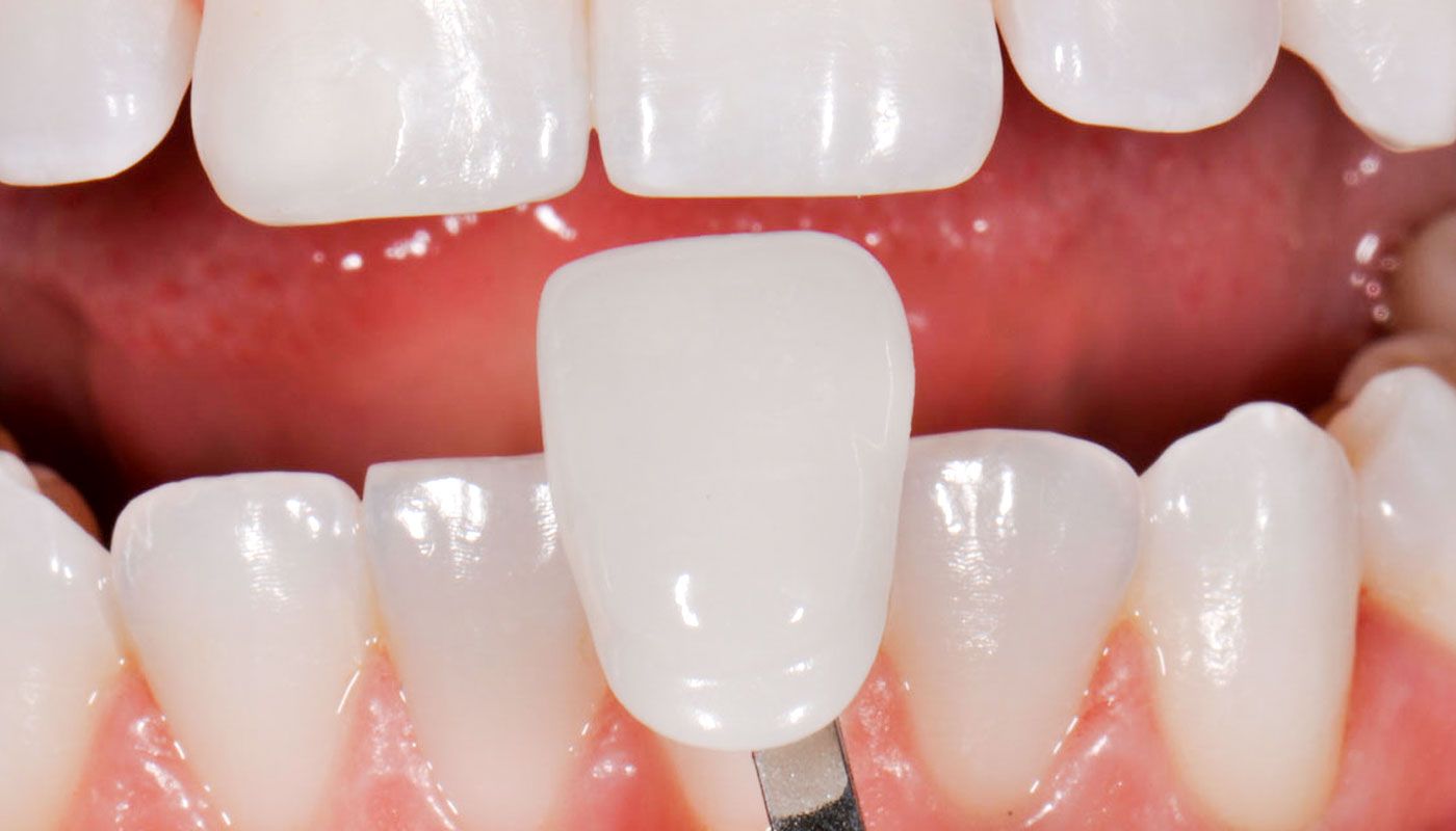 Композитные виниры стоматология