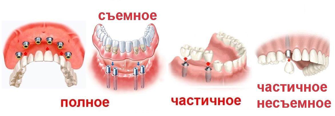 Возможно частично. Съемные ортопедические конструкции в стоматологии. Съемное и несъемное протезирование. Несъемные ортопедические конструкции в стоматологии. Конструкции зубных протезов при частичном отсутствии зубов.